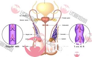 精索静脉曲张可以做泰国试管婴儿吗