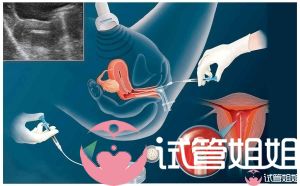 人工授精成功率和费用详解