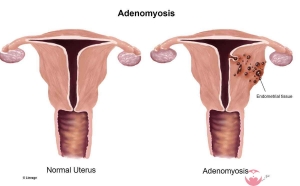 腺肌症是什么病？可以做泰国试管婴儿吗？