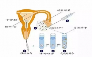 一代试管和二代试管的区别具体有哪些？