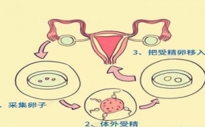 试管婴儿做一次多少钱？应该如何备孕？-第三代试管婴儿百科