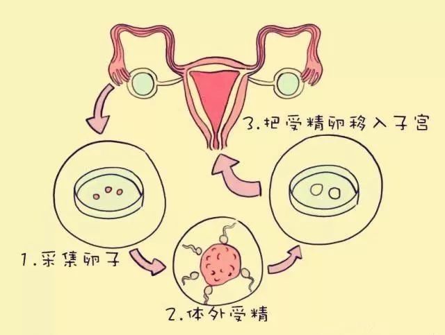 可以试管双胞胎吗