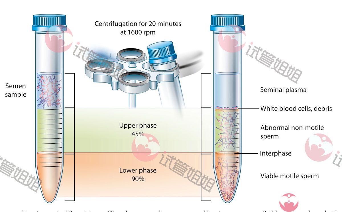 洗精术-泰国试管婴儿