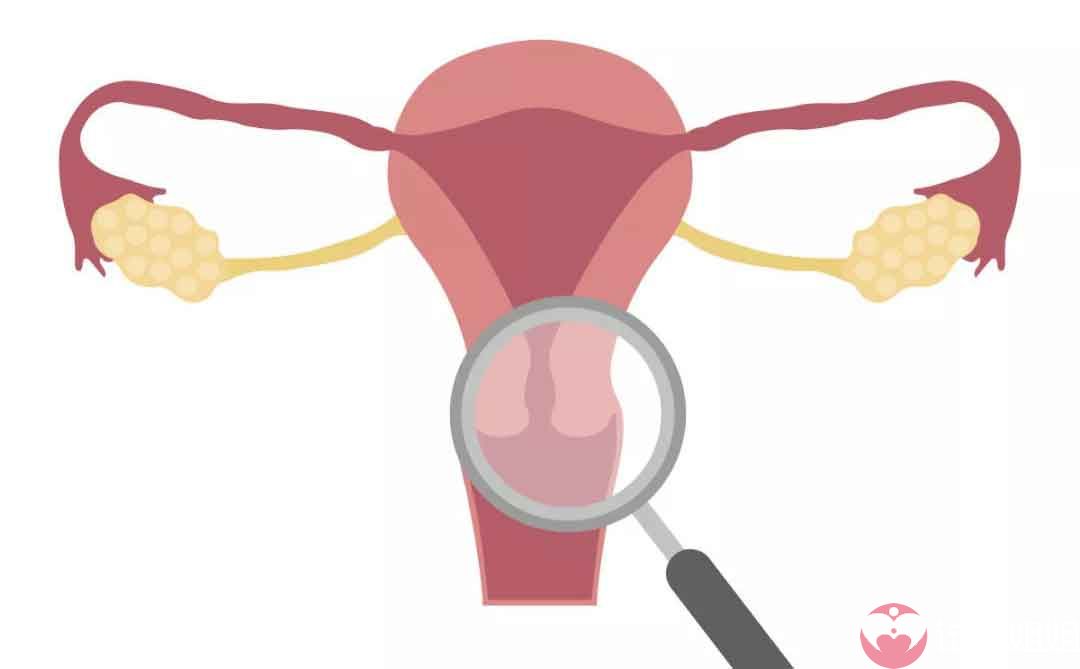 女性做广州三代试管婴儿过程中发现患有巧克力囊肿怎么办